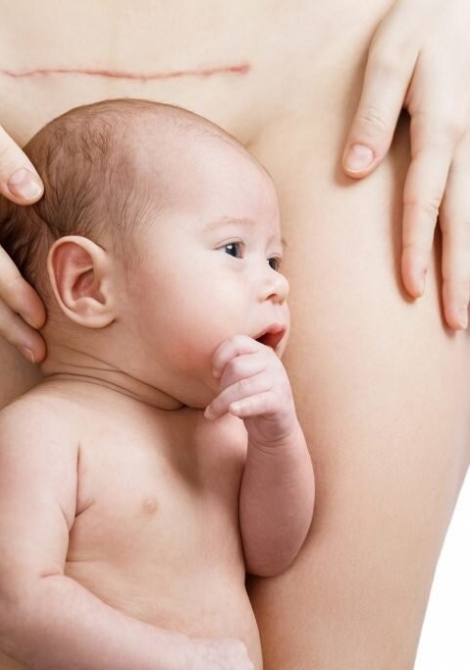 Cesarean-awareness-1024x682.jpg